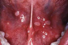 ulceration springerlink