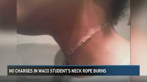 rope burns s neck on trip