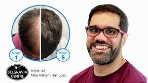 belgravia male hair loss treatment