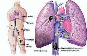 Plicní embolie, perzistující plicní hypertenze; Pulmonarni Embolie Priznaky Priciny A Lecba Cs Imevictoria Com