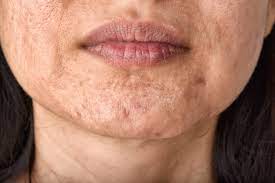 skin problem and aging acne scar