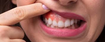 swollen gum behind molar causes