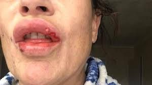 mom s lips left oozing pus after low