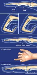Pitcures of the tendons in tbe forearm : How Do I Know If I Have A Flexor Tendon Injury Orthopaedic Associates Of Riverside