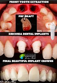 front tooth zirconia implants