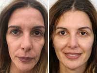 affordable face lift surgery india s