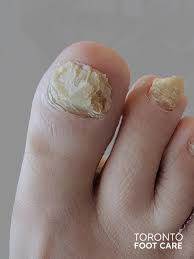 permanent toenail removal toronto