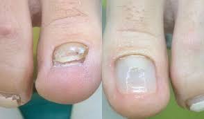 nail prosthetics is a common practice