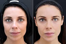 Most dermal fillers are based on hyaluronic acid ( juvederm®, restylane®, belotero® balance. Thinking Of Having Face Fillers Things You Need To Know Before Booking The Beauty Procedure Lynne Hyland Mirror Online