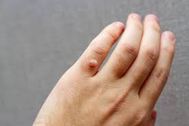wart removal treatment in delhi dr