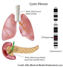 cystic fibrosis nclex questions