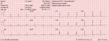 Large Block Method To Calculate Heart Rate Ecg Medical