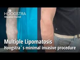 multiple lipomatosis hoogstra s