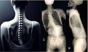 脊柱変形、思春期特発性側弯症 | 整形外科医 石井賢 オフィシャルサイト