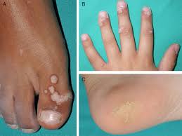 treatment of warts in children an