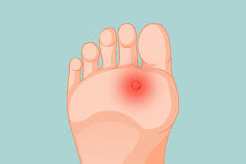 removing plantar warts why is it so