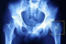 hip fracture types and complications