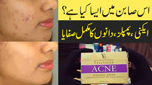 acne pimples simple solutions a