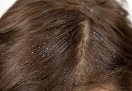 Check spelling or type a new query. Lice Vs Dandruff Differences Pictures And Symptoms