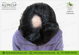 alopecia areata treatment types causes