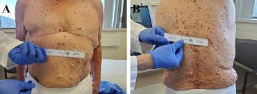 Also known as von recklinghausen disease, nf1 mostly affects nerves of the outer parts of the body (peripheral nervous system). Cureus Contralateral Breast Cancer With Multiple Primary Neoplasms In A Patient With Neurofibromatosis Type 1 A Case Report And Review Of The Literature