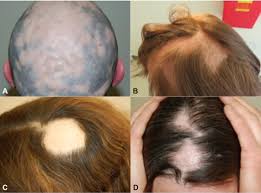 Alopecia is hair loss or balding. Alopecia Areata Disease Characteristics Clinical Evaluation And New Perspectives On Pathogenesis Sciencedirect