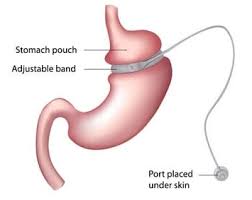 lap band vs gastric sleeve which