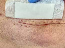 6 causes of post lipo fibrosis and how