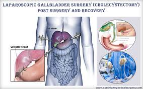gallbladder post surgery effects and