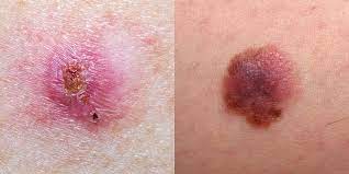 What does skin cancer stages indicate? Skin Cancer Pictures 5 Different Types Of Skin Cancer To Know