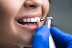 Image result for what all does a dentist do during a cleaning