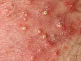 When this happens to you, you may want to know how to cure it properly and correctly, right? Spa Pool Folliculitis Dermnet Nz