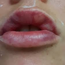 white patch after juvederm on lips will