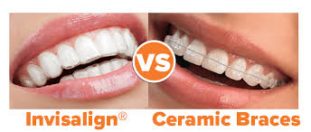 Check spelling or type a new query. How Much Do Clear Braces Cost Vs Invisalign Ncoso