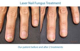 laser nail fungus treatment