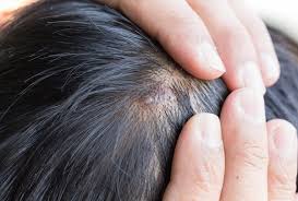 how to treat scalp sores ehealth