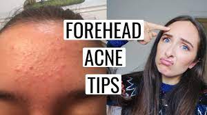 how to get rid of forehead acne 9
