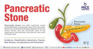pancreatic stones causes symptoms