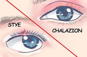 chalazion and stye eye day clinic