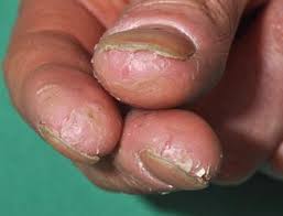nail alterations in hand eczema