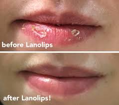 lanolips is basically a miracle balm