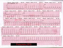 It occurs when a short circuit rhythm develops in the upper chamber of the heart. A Case Of Supraventricular Tachycardia Associated With Wolff Parkinson White Syndrome Chee Journal Of Medical Cases