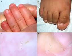 periungual scabies in infants a tough