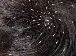 Check spelling or type a new query. Head Lice Causes Symptoms And Treatments