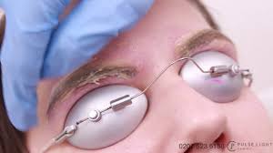 laser eyebrow tattoo removal procedure