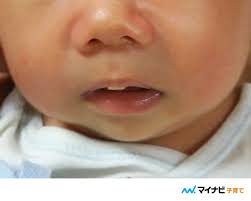 助産師解説】赤ちゃんの吸いだこ〜唇にできる原因&対処法
