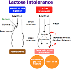 Lactose Intolerance Pediatrics Biochemistry Physiology