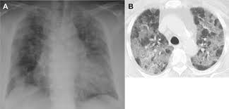 A 72 Year Old Woman With Respiratory