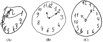 In a study, normal people scored an average of 27.4; Three Examples Of Clock Drawing Test Cdt Using Rouleau Et Al S Download Scientific Diagram
