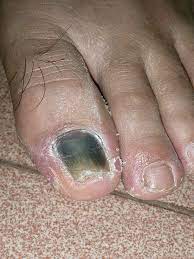 is your toenail falling off foot